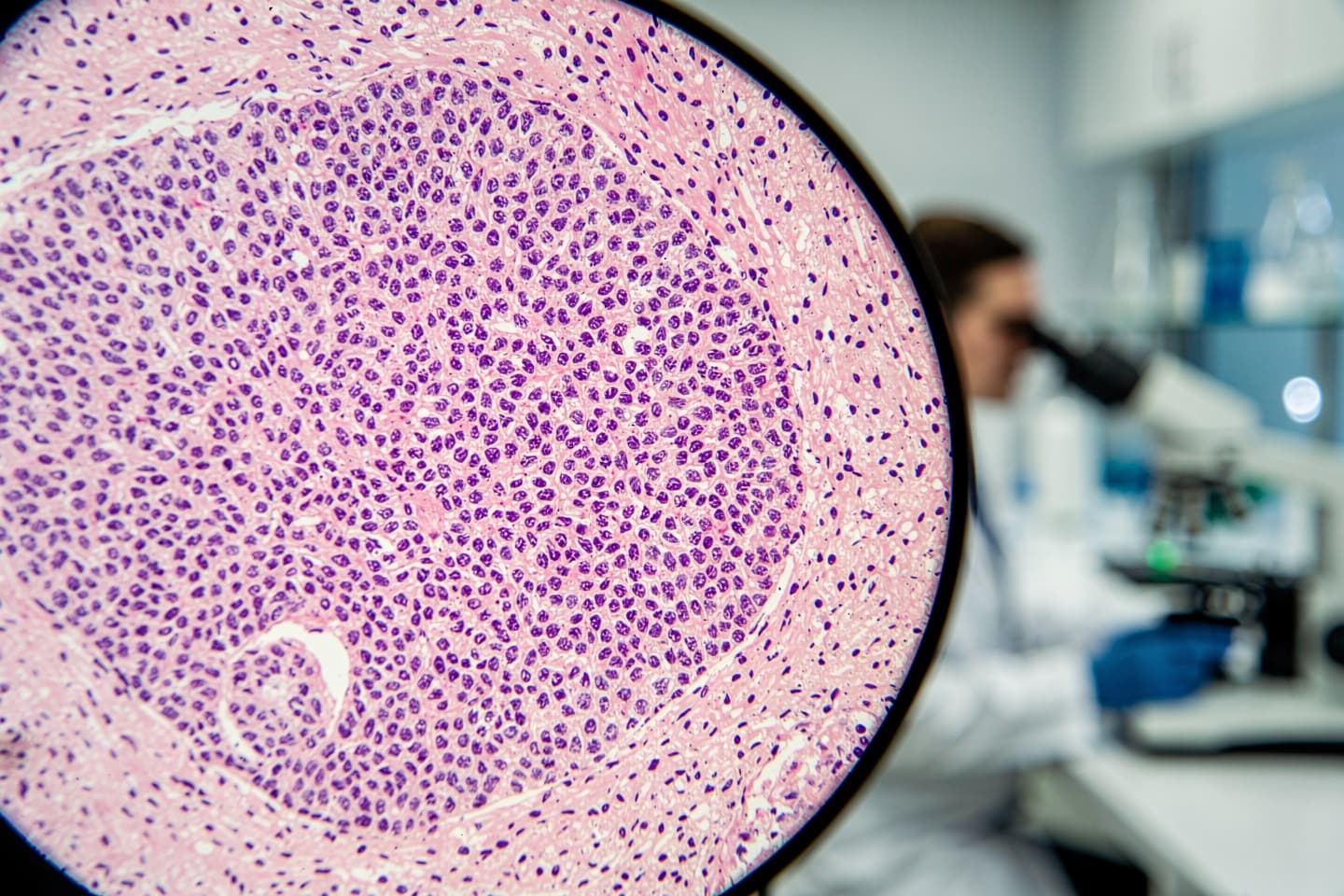 Limfom periferic cu celule T asociat imunosupresiei