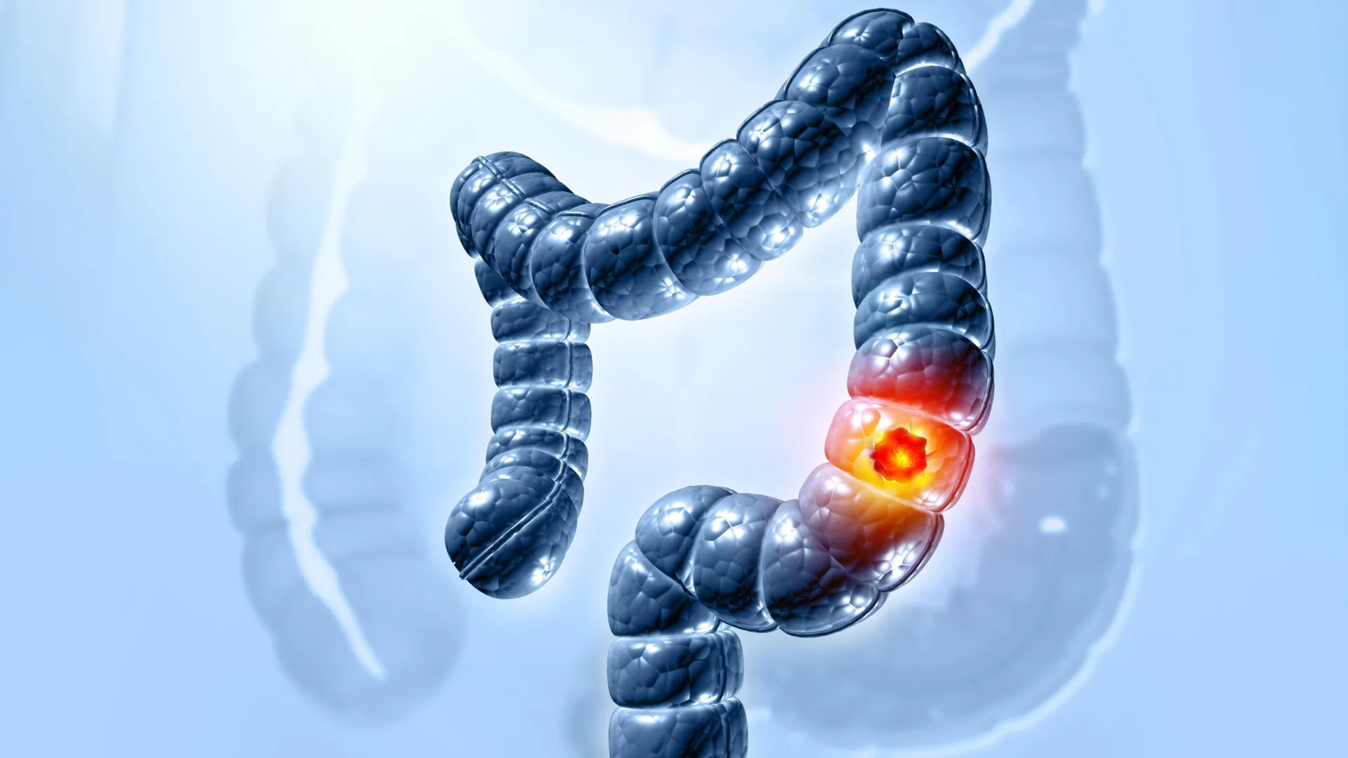 Cum declanșează o bacterie intestinală cancerul de colon — misterul rezolvat