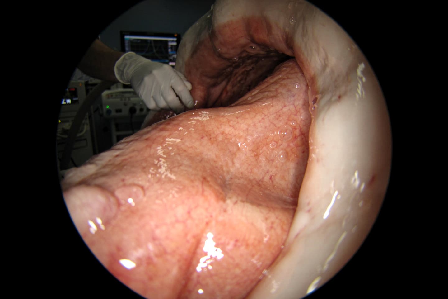 Metaplazia intestinală — singura leziune precursoare a adenocarcinomului esofagian