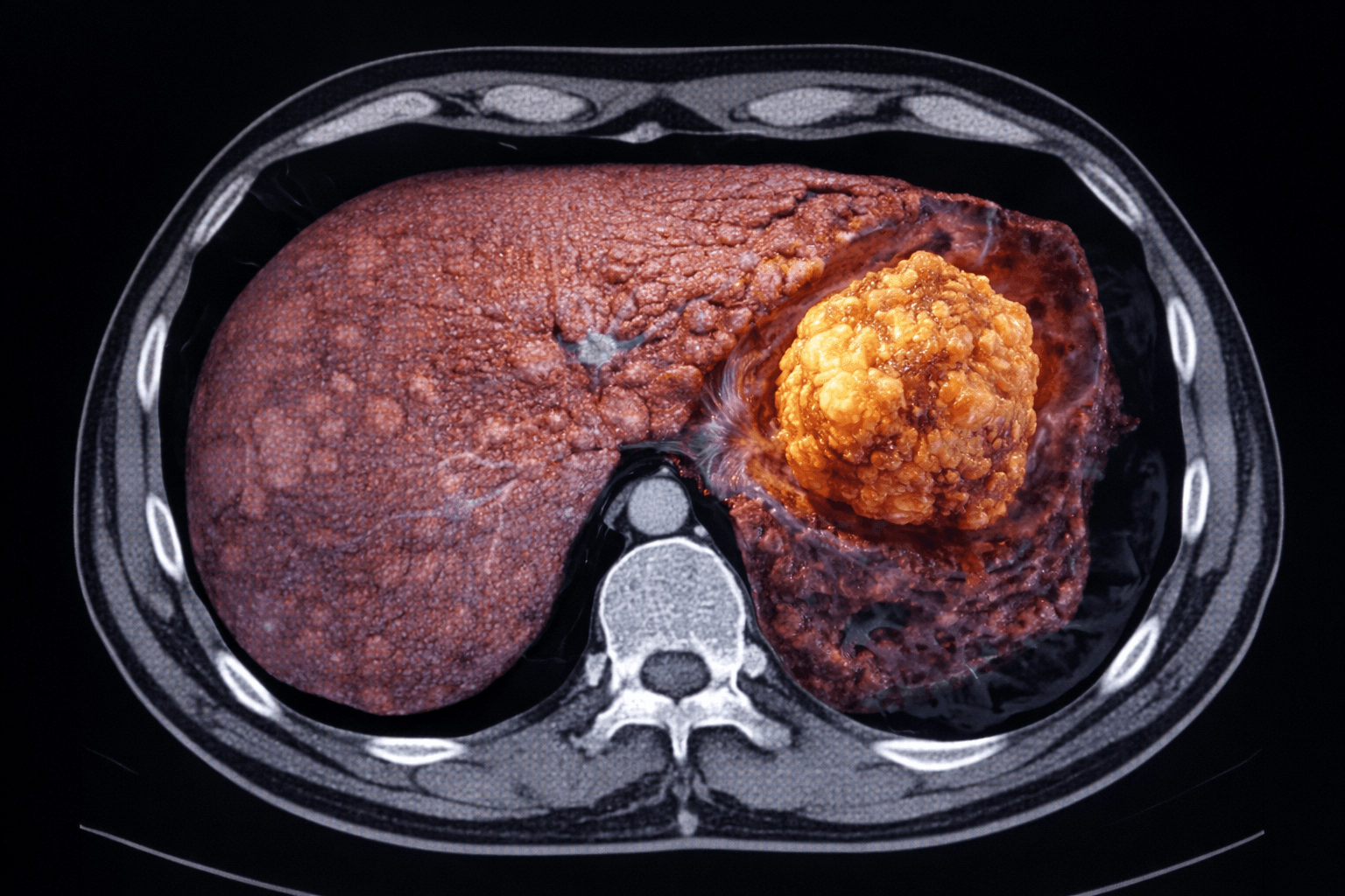 Restricția proteică poate încetini progresia cancerului hepatic la pacienții cu ficat bolnav